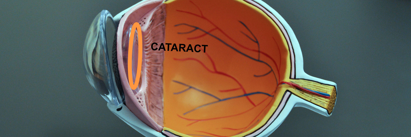 Cataract Surgery - IRIS Surgery